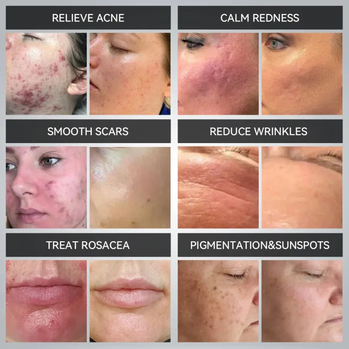 β¨ 7-Color LED Light Therapy Mask β Professional Spa-Quality Skincare at Home! β¨