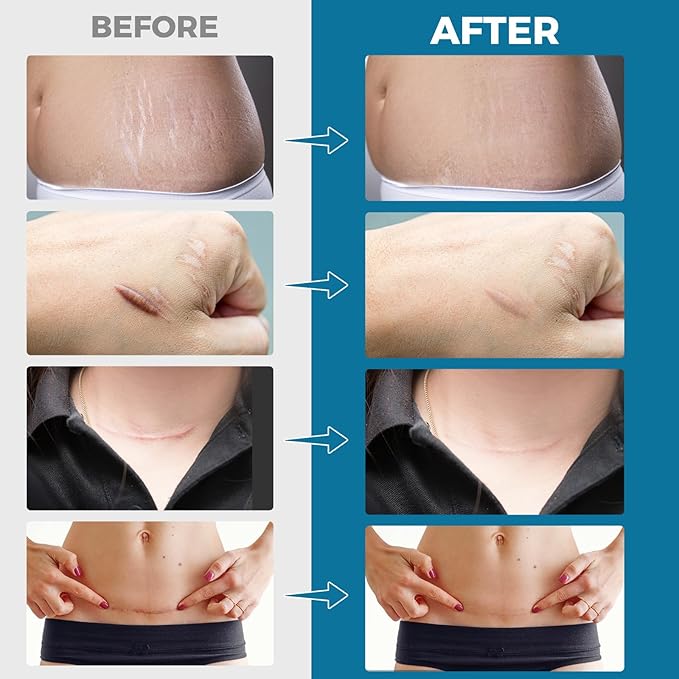 ScarErase™ Invisible Silicone Scar Patch