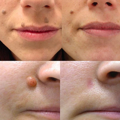 Skin Tag & Mole Remover Pen
