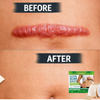 ScarPatch™ SmoothSkin Medical-Grade Silicone Scar Repair Sheets (2 Rolls)